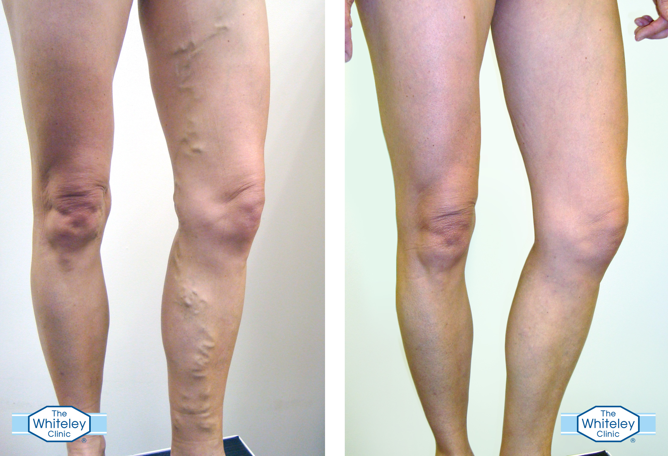 Varicose Veins Everything You Need To Know My Weekly