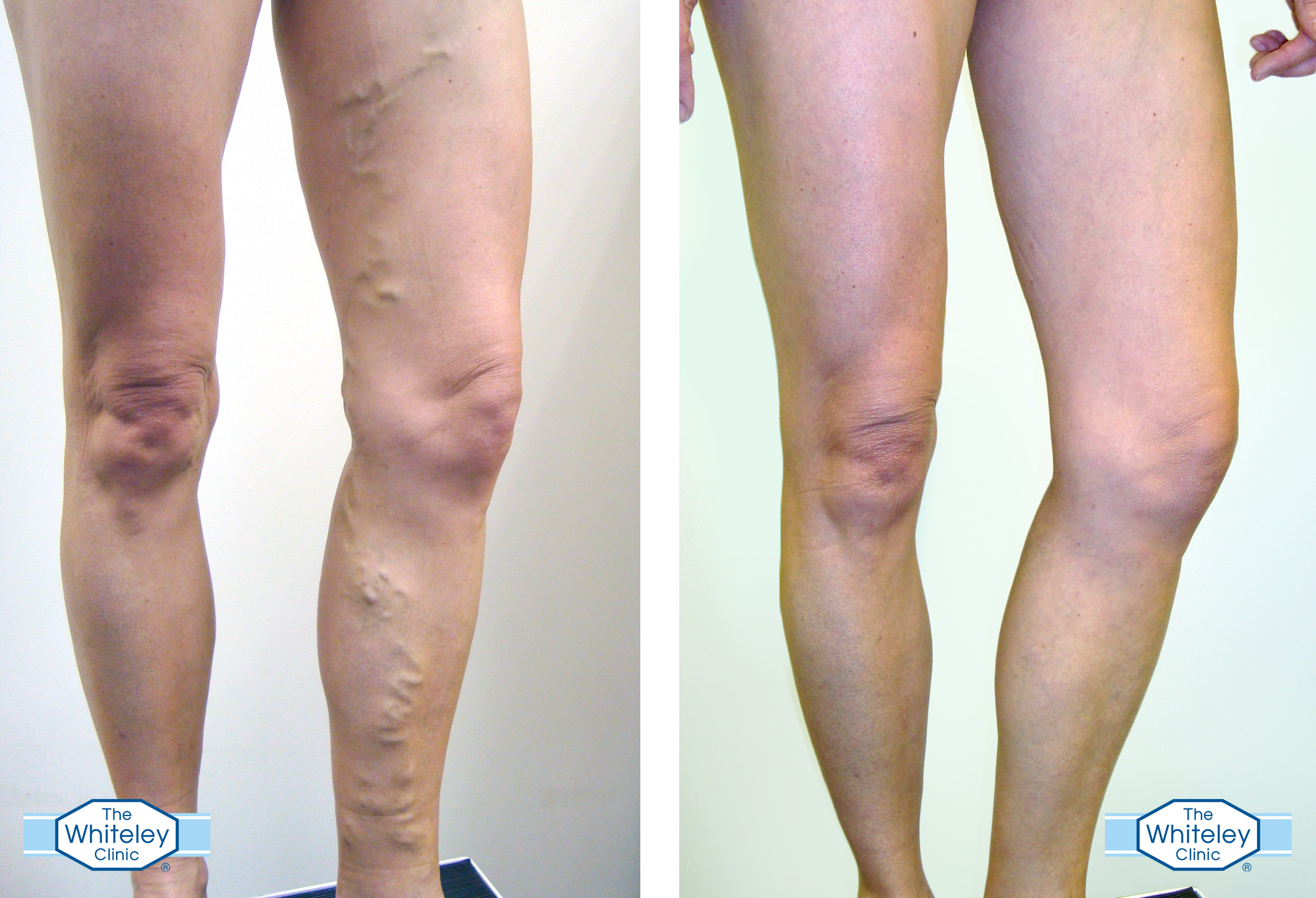 varicose vein surgery