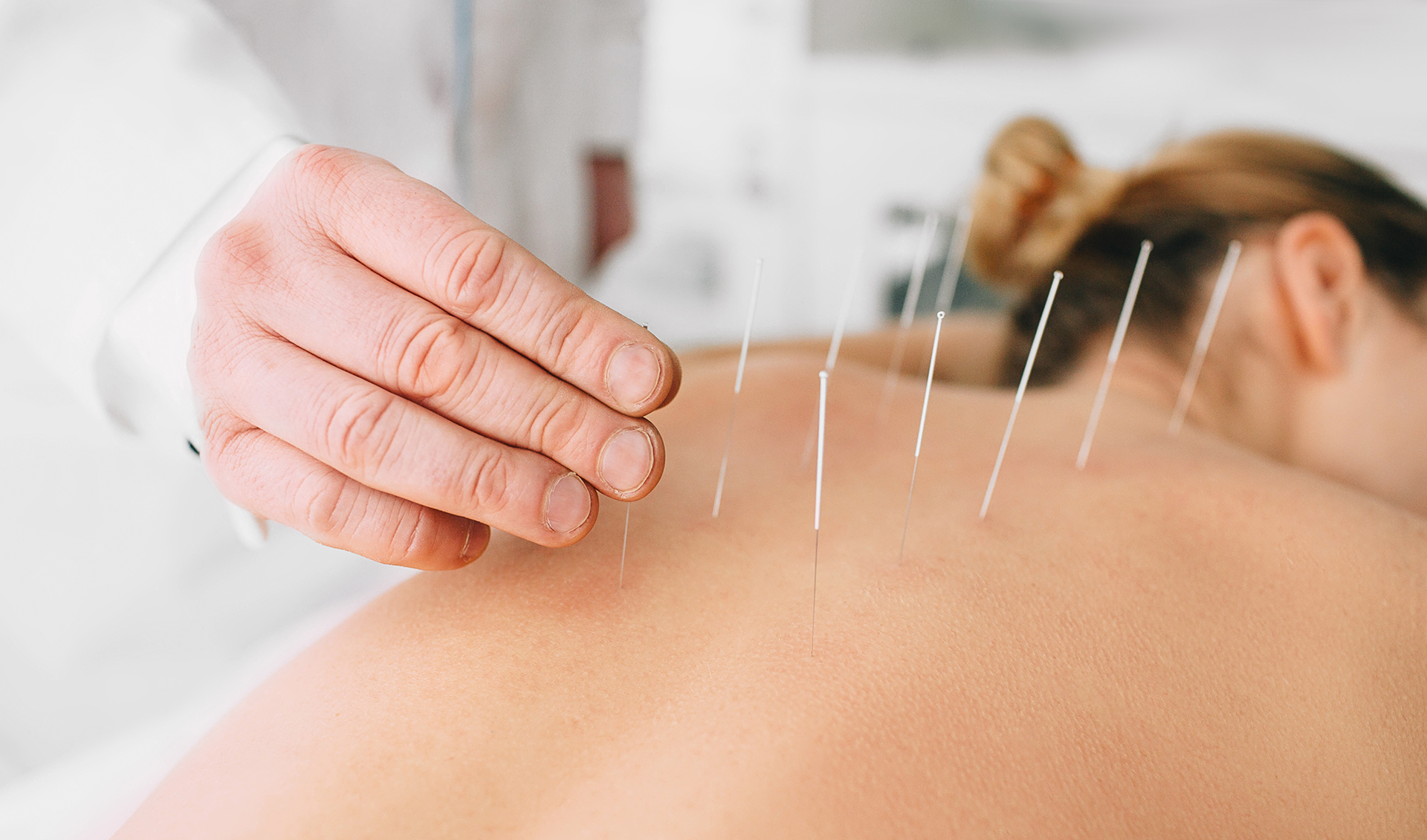 Acupuncture Needles