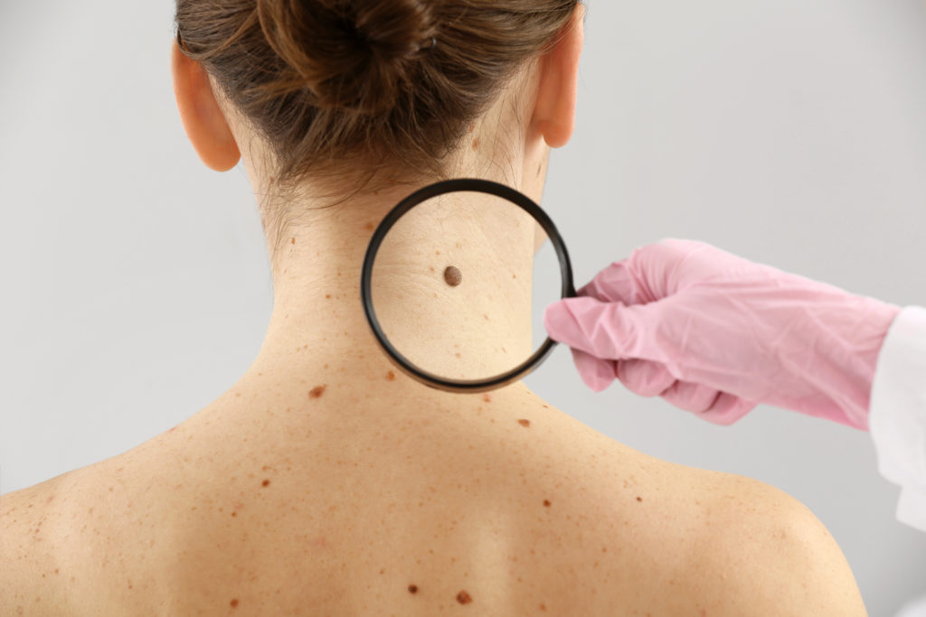 Doctor examining woman's moles